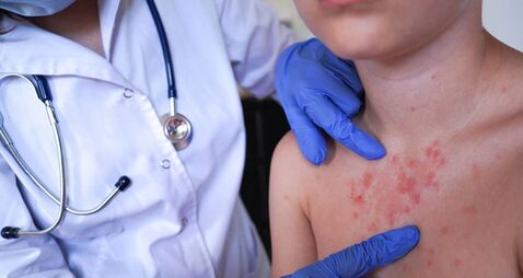 Scabies outbreak among students at Waterford’s SETU campus Scabies outbreak among students at Waterford’s SETU campus